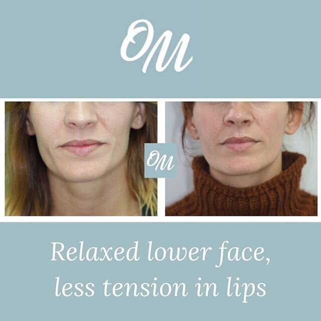 Great results in seven weeks. This lovely lady is experiencing less facial pain and tension, and loves the aesthetic changes she has achieved so far. She feels she has her fuller, youthful face back. ⠀
⠀
Through her dedication to her therapy and trus