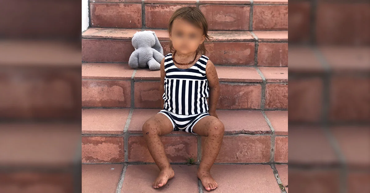 LISTEN: Mastocytosis. The disease that changed Mommy Nicol and her baby’s life forever.