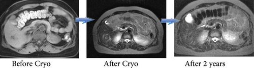 Liver Cancer captured Before and after being treated with cryo. http://puhuahospital.com/treatments/cancer/cryosurgery
