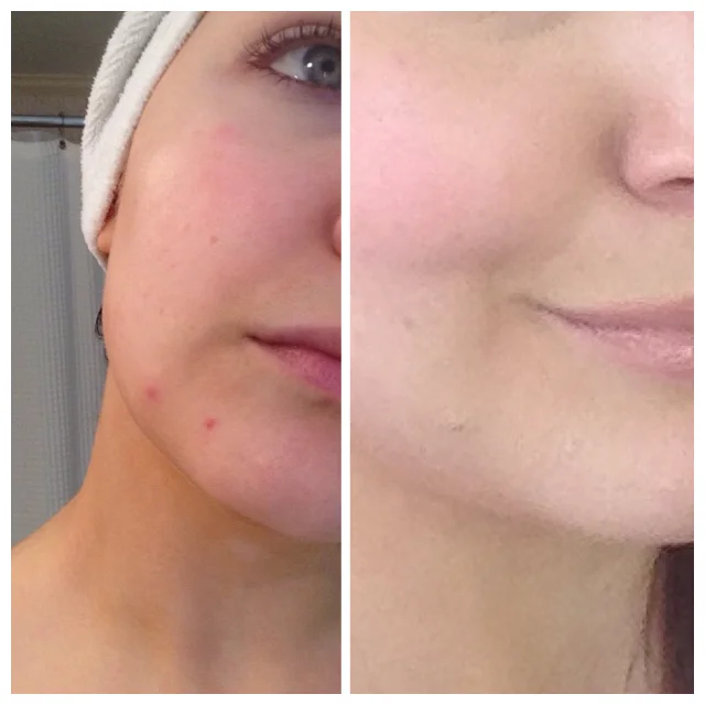 Let's Talk About Zits, Baby