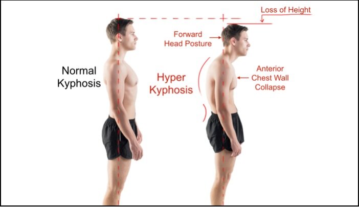 Can poor posture affect your height? — SpinalCare Sydney Olympic