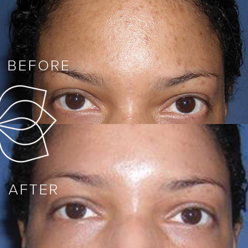 facialpeel1.jpg