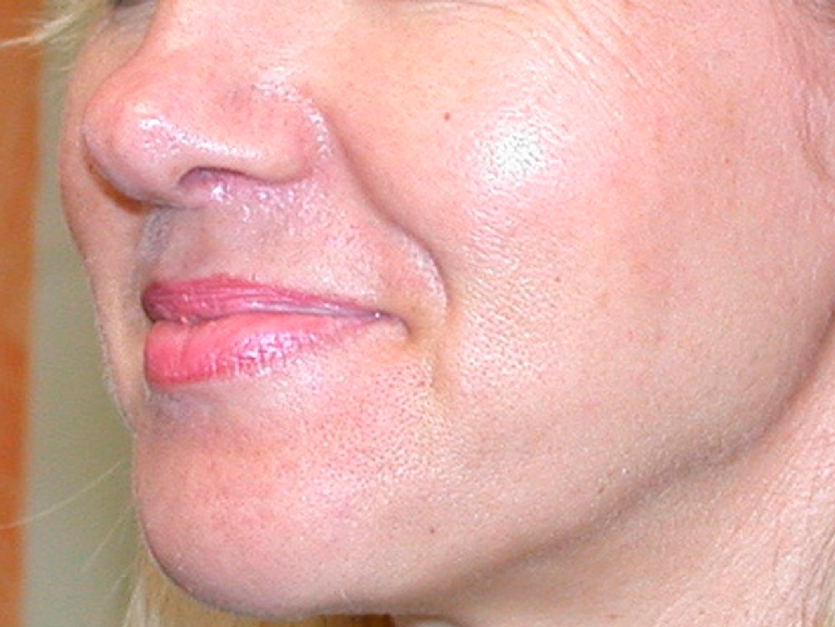 oily-pores-and-enlarged-pores-before-and-after-2.jpg