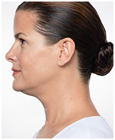 Jennifer_Before Kybella.png