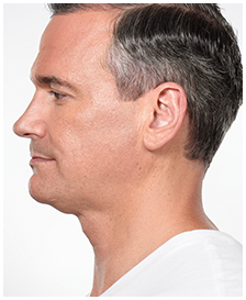Andy_After Kybella.png