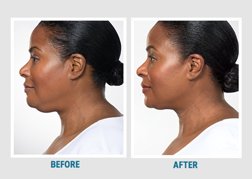 before after Kybella under the chin NO stats.png