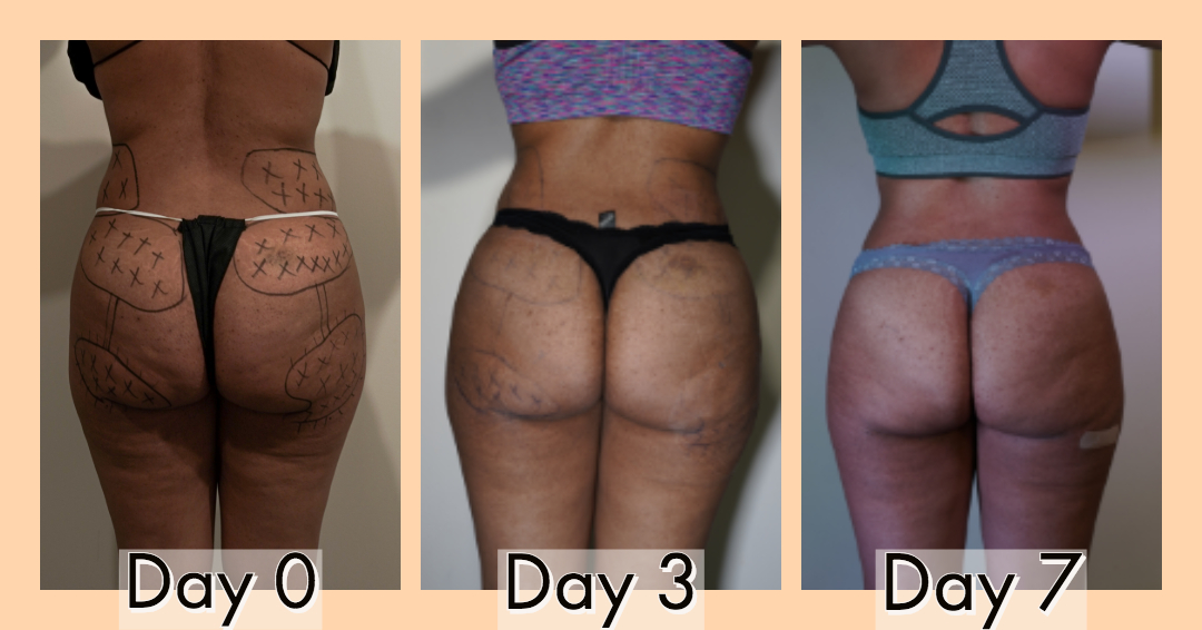 Erica Day 7 back.jpeg