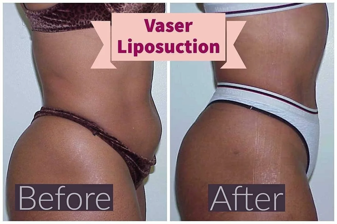 vaser lipo before after abs side view.jpg