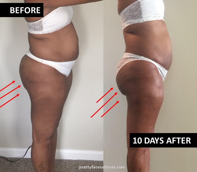 LH vaser lipo fat transfer back before after 01.png