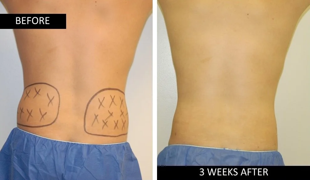 ri love handles before after lipotherme.jpg