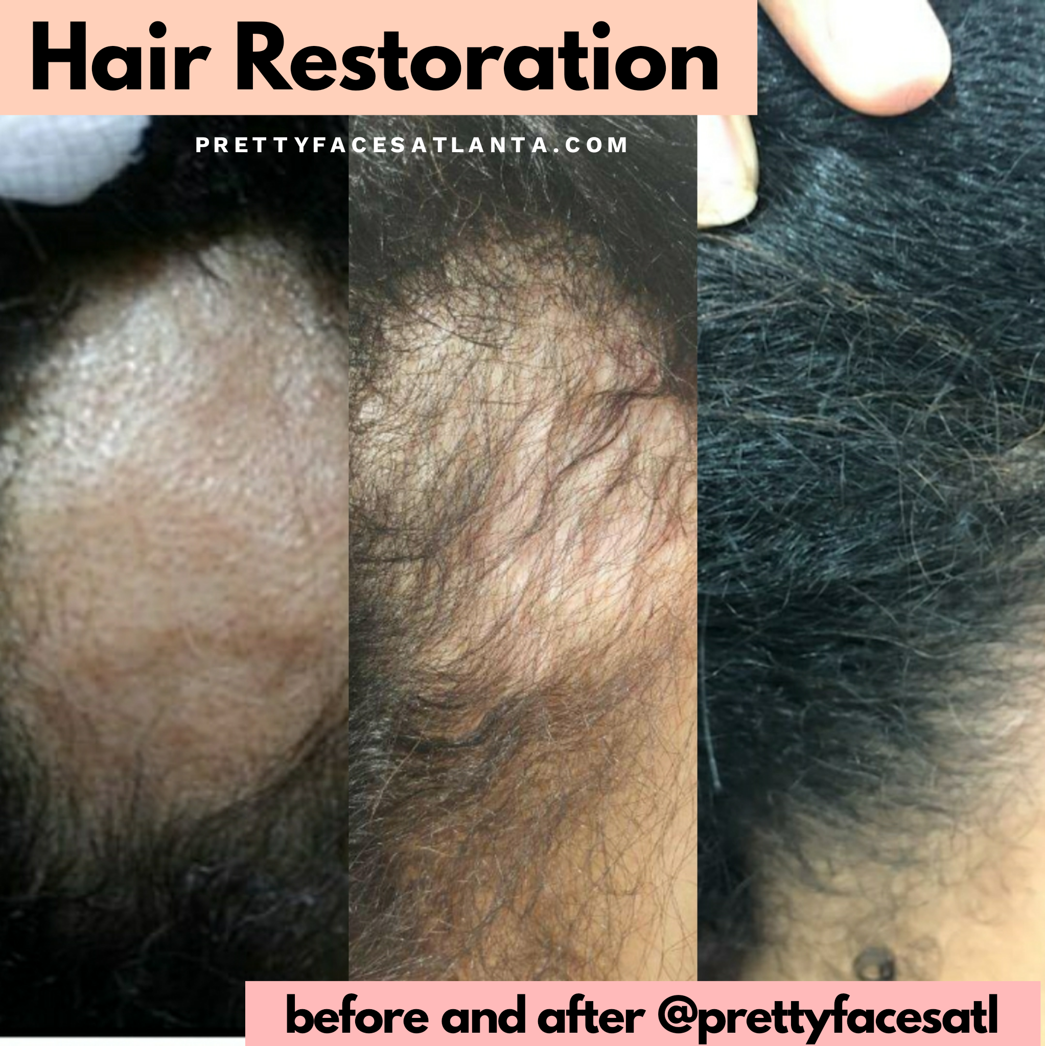 before after hair restoration.png