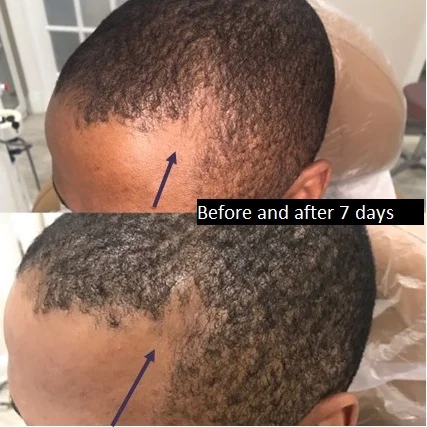 male hair after exosomes placement one week 01.jpg