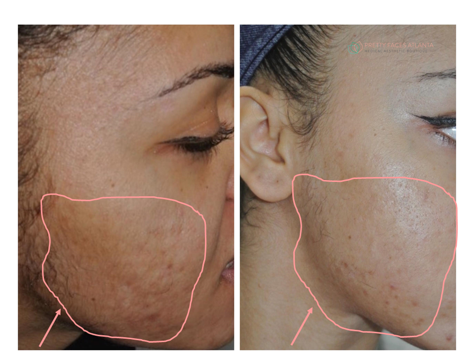 before and after derma with prp for IG story.png