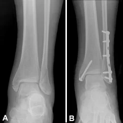 ANKLE FX.jpg