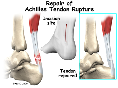 10 Products for Achilles Tendonitis and a Ruptured tendon.