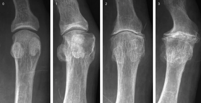1ST MPJ ARTHRITIS.jpg