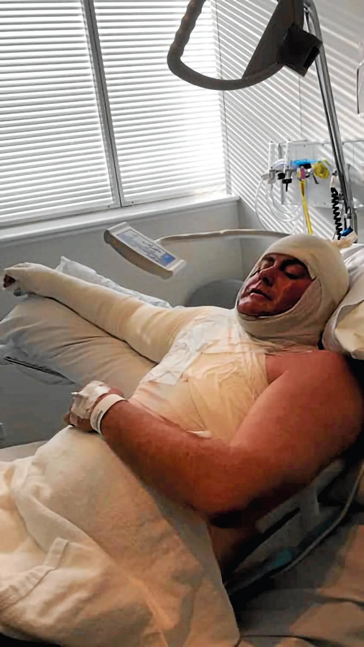 • Marcus Casey is recovering in the Royal Hobart Hospital from second and third degree burns to his body after an accident on Sunday afternoon.