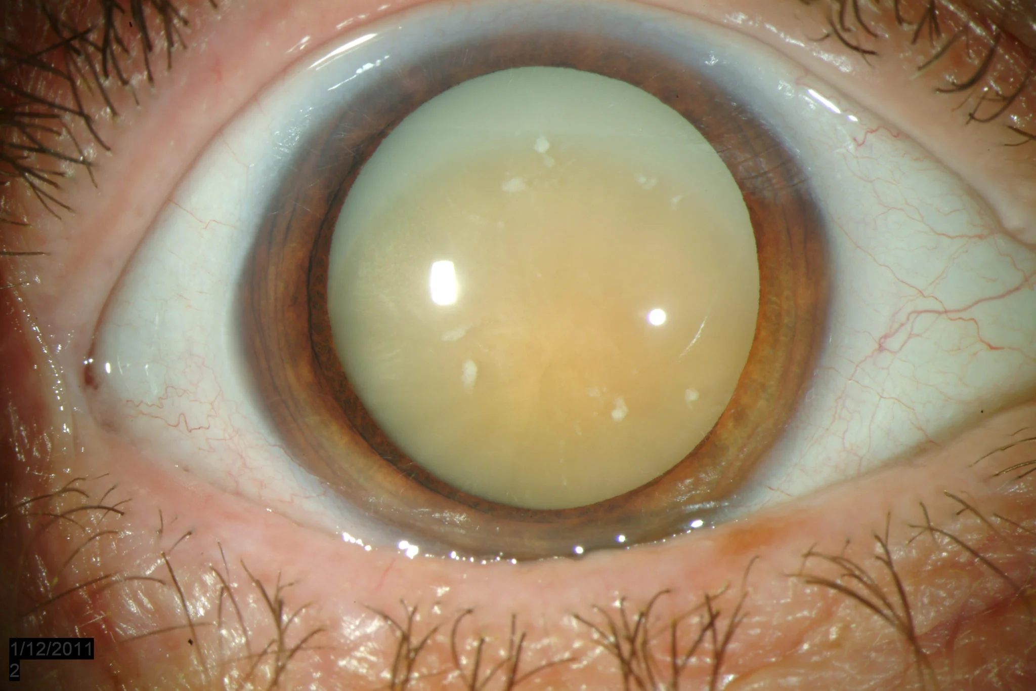 Morgagnian-Cataract-1.jpg