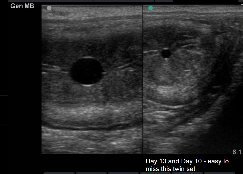 Pictures of pregnancy ultrasound