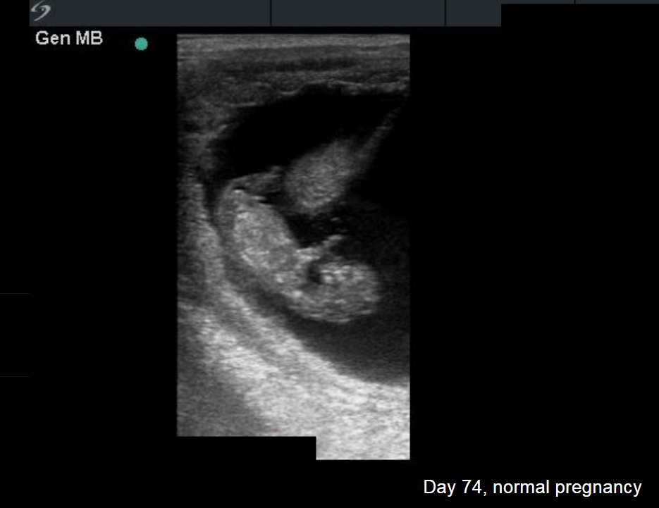 Day 74, normal pregnancy 