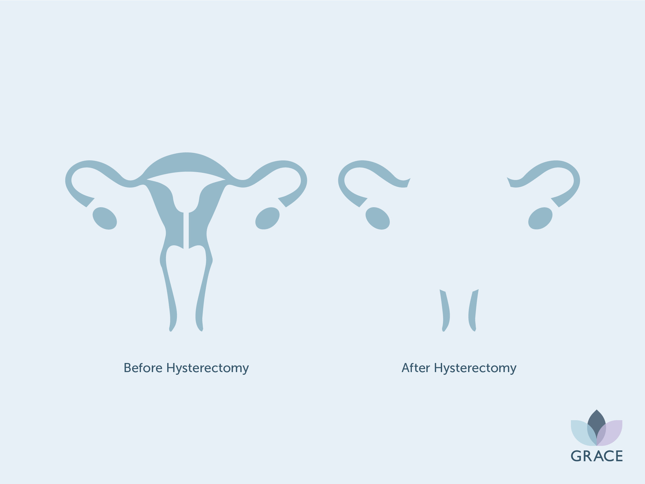 Female reproductive system before and after hysterectomy