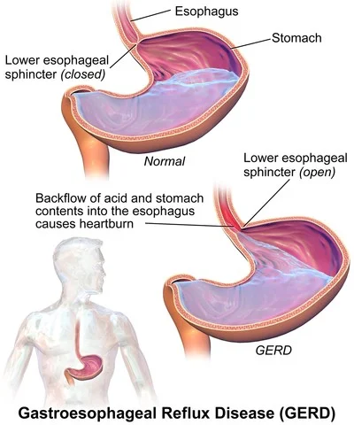 Gastroesophageal Reflux Disease: You and Your Healthy Belly - Part 2