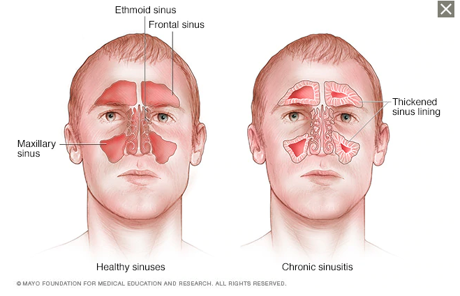 Are Your Sinuses Healthy Is Mold The Culprit Philadelphia Integrative Medicine