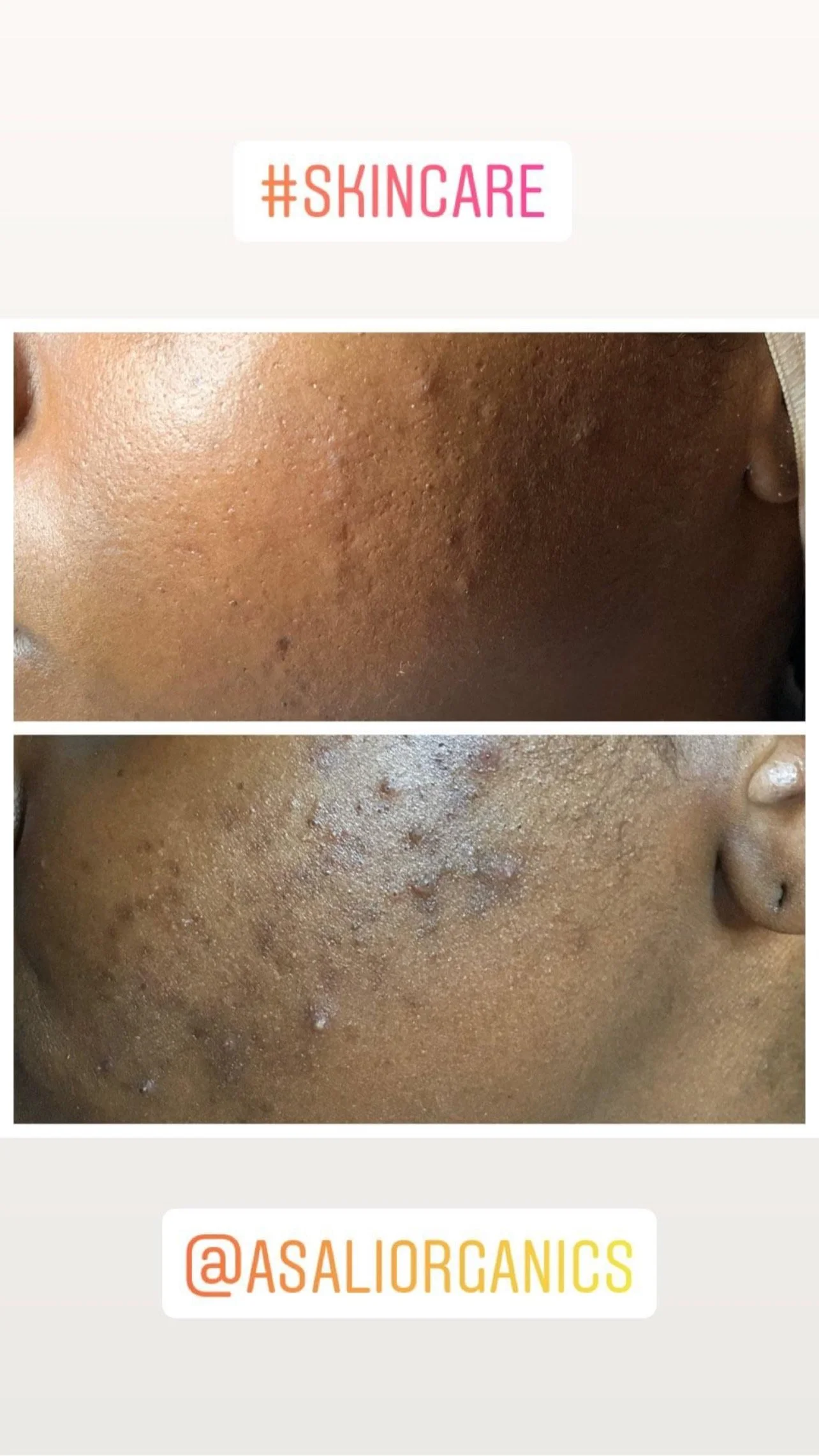 Before / After Hyperpigmentation  (Copy)