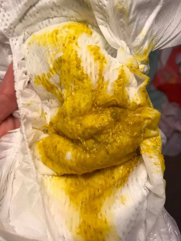 breastfed-baby-poop-mucus-pictures-milkology