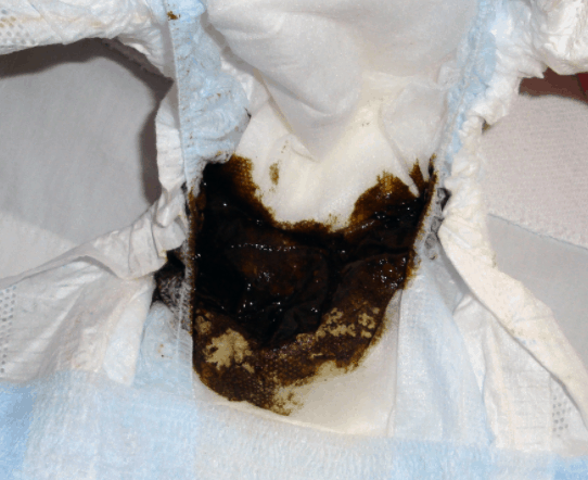 how-often-should-a-breastfed-baby-poop-milkology