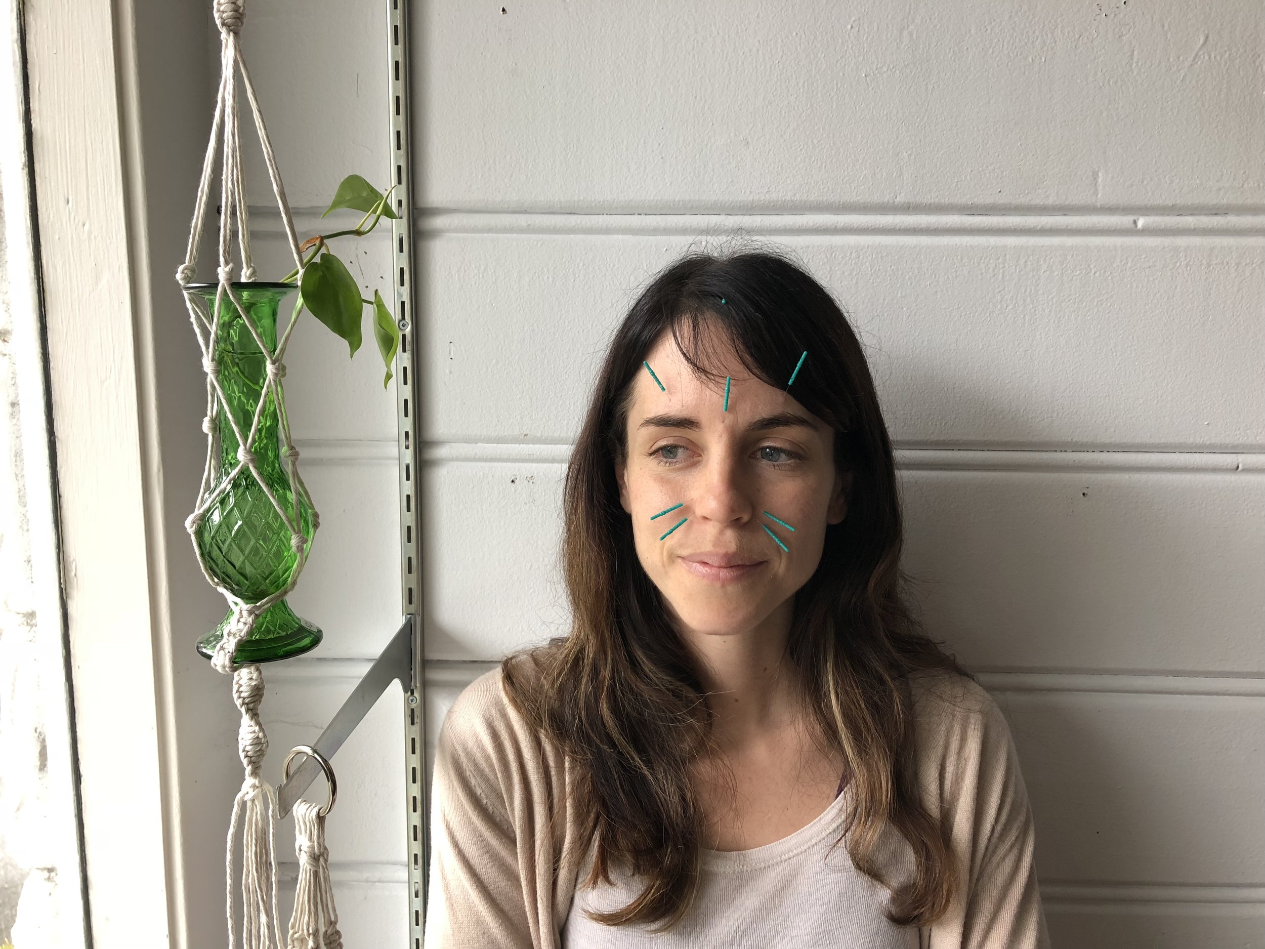A selection of local acupuncture points for seasonal allergies. I normally choose 2 - 3 local acu-points, an ear point, as well as distal points that treat both allergies and constitutional imbalances.