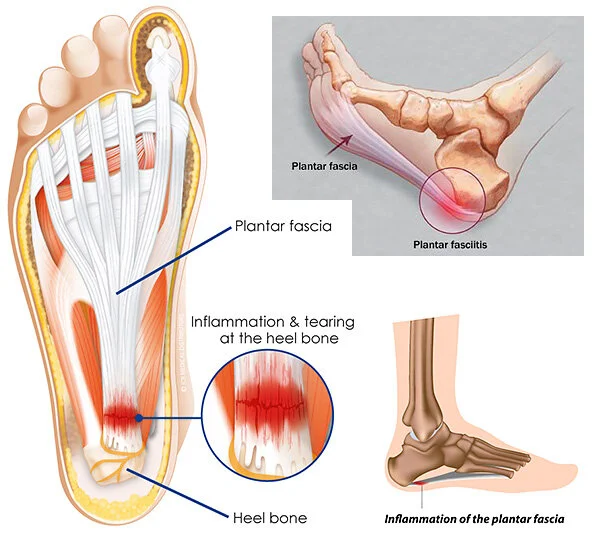 Uric Acid Pain In Heel Area Of Foot Uric Acid Back Of Heel Hurts