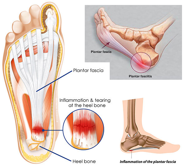Plantar Fasciitis / Foot Pain - News & Info - Abingdon Therapy Services