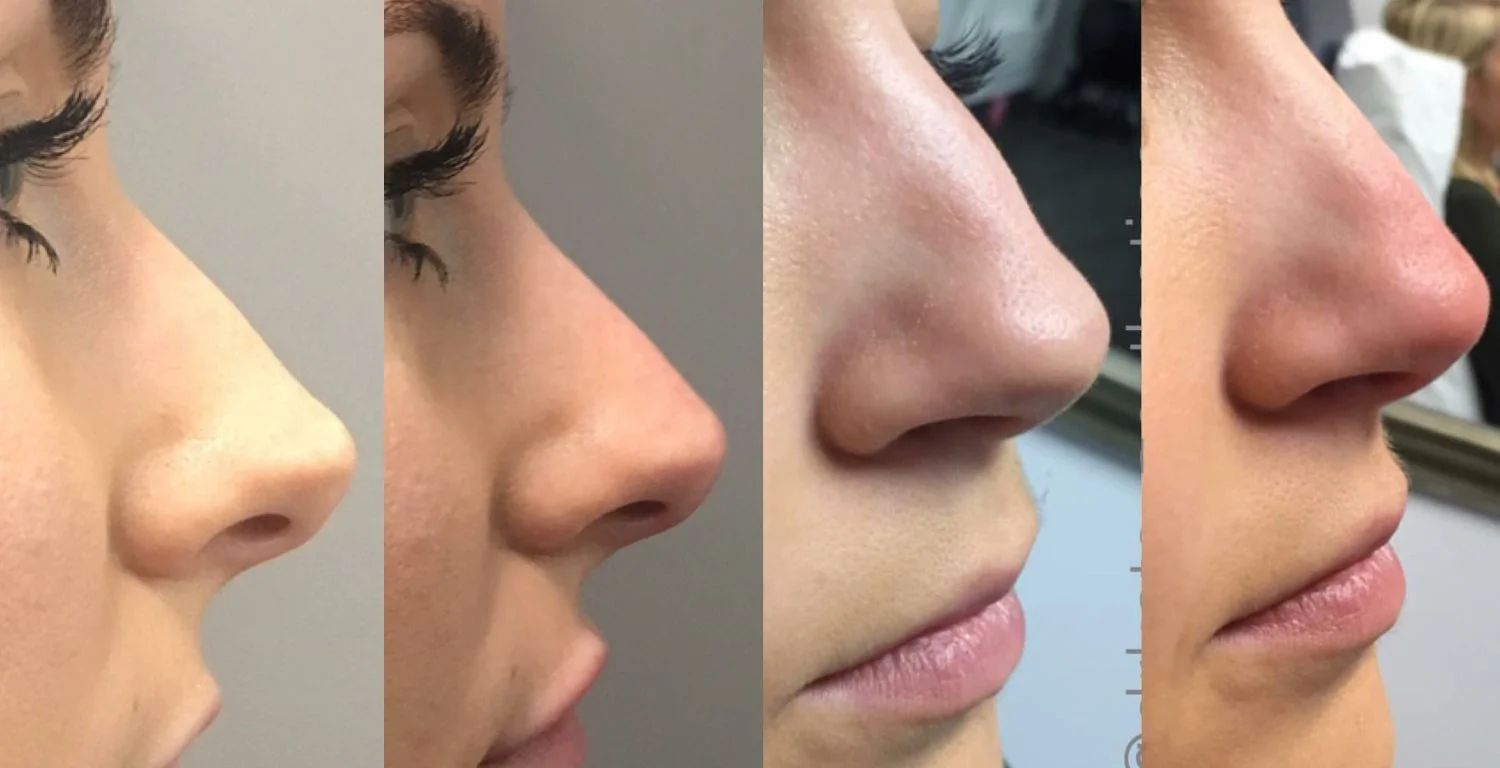 2018-rhinoplasty-non-surgical-before-after.jpg