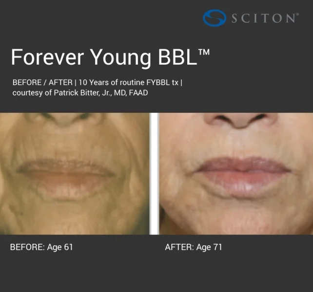 BBL - dark forever young before and after 2.jpg