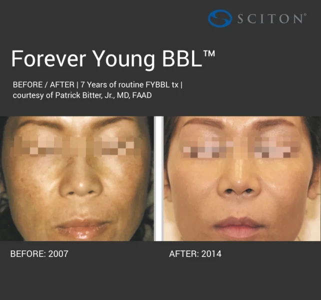 BBL - dark forever young before and after 5.jpg
