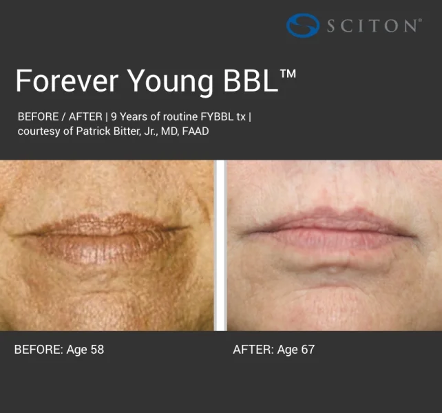 BBL - dark forever young before and after 6.jpg