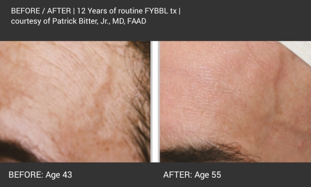 Before and after images of a client who received Forever Young BBL treatment over 12 years