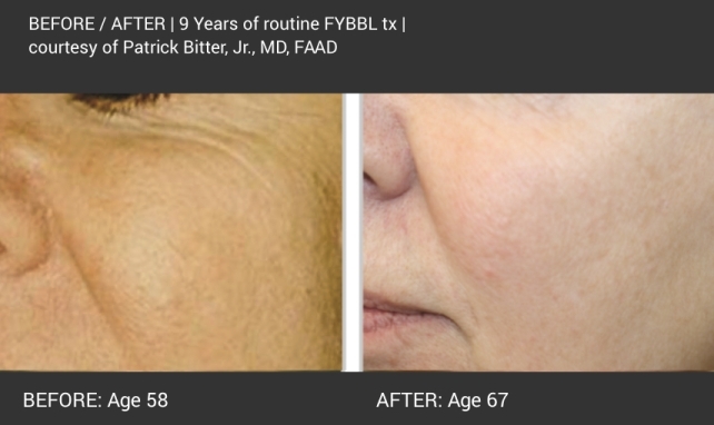 Before and after images of a client who received Forever Young BBL treatment over 9 years