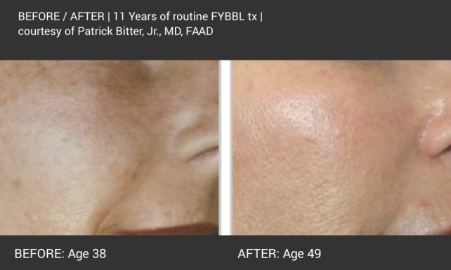 Before and after images of a client who received Forever Young BBL treatment over 11 years