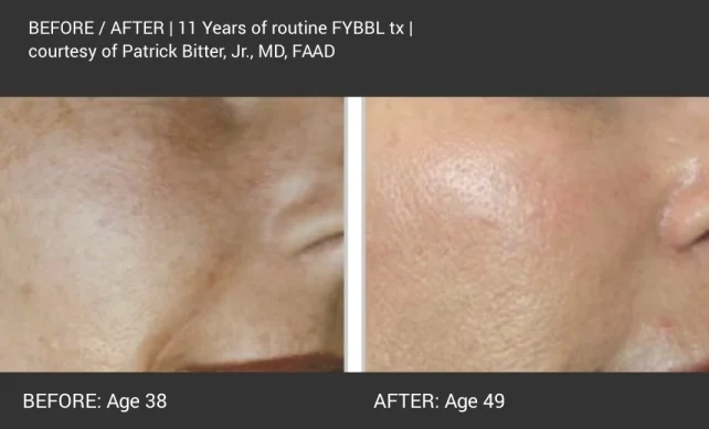 BBL - dark forever young before and after 3.jpg