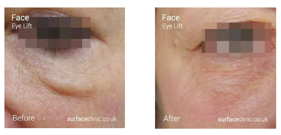 endybleph b and a 2.png