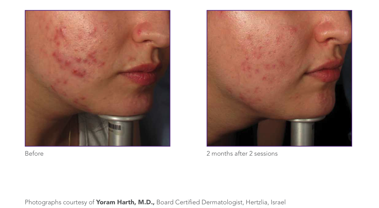 cystic acne.png