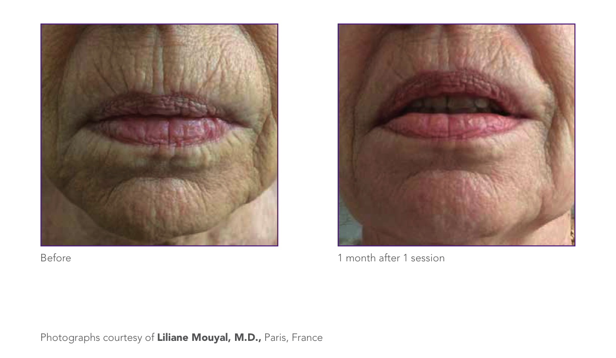 wrinkle reduction 1.png