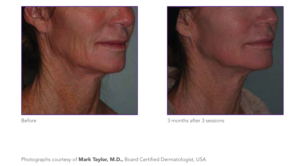 wrinkle reduction 2.png