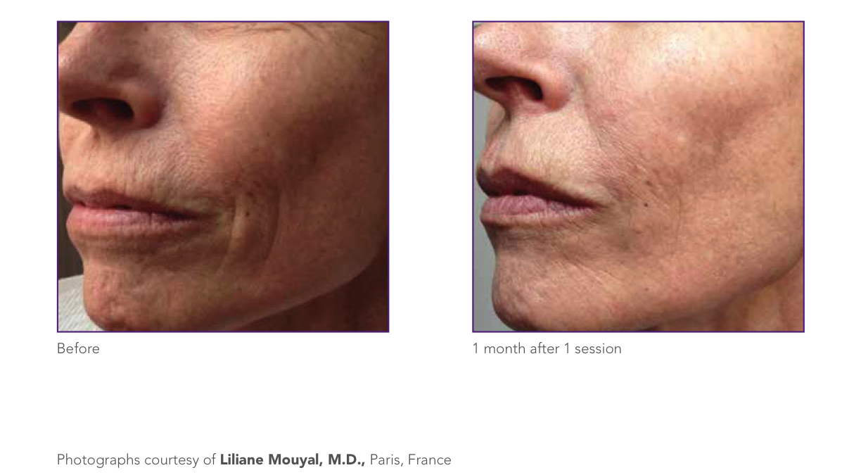 wrinkle reduction.png