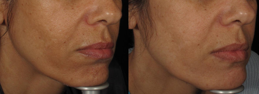 Treating Melasma + Skin Texture With RF Fractional Skin Resurfacing (FSR)