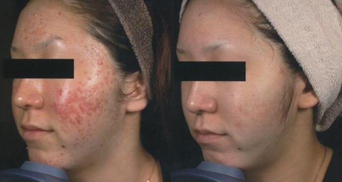 Acne Treated with RF Fractional Skin Resurfacing (FSR)