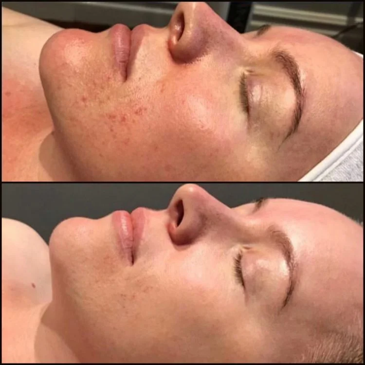 BBL Targeting Rosacea and Redness