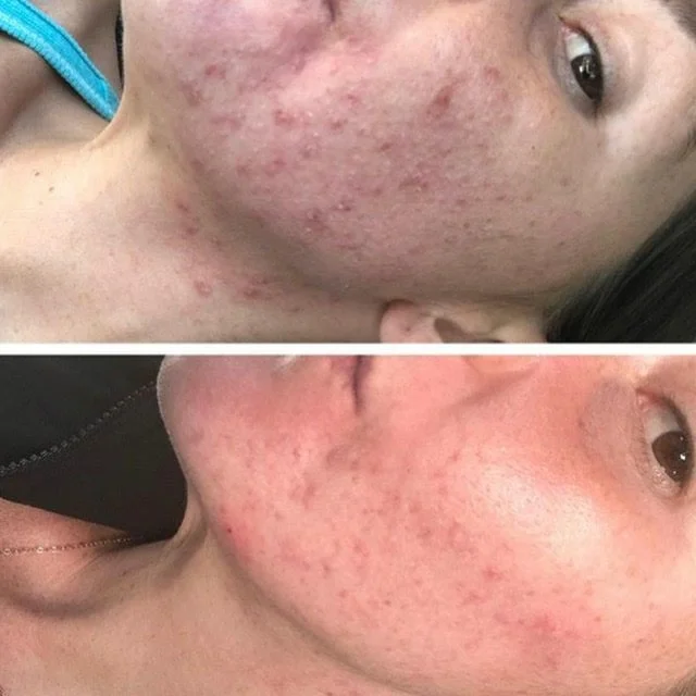 Acne Treated with Acnelan Program